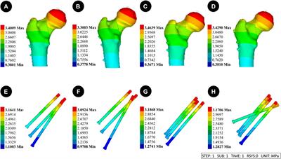 Biomechanical study of a biplanar double support screw (BDSF) technique based on Pauwels angle in femoral neck fractures: finite element analysis